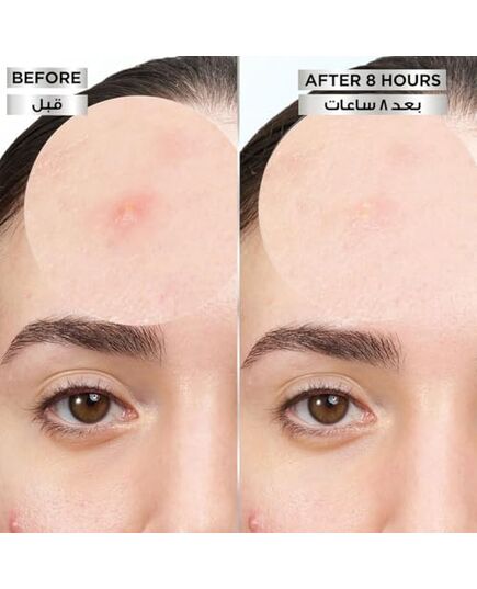 Garnier Pimple Patch Fast Clear 8 Hours Invisible