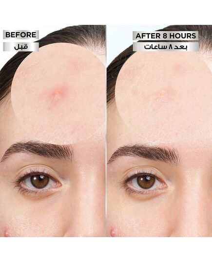 Garnier Pimple Patch Fast Clear 8 Hours Invisible